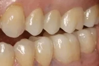A close up of a person 's mouth with white teeth.