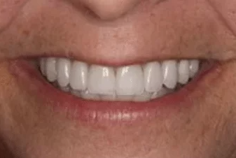 A close up of a man 's mouth with white teeth.