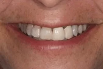 A close up of a man 's mouth with white teeth.