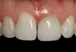 A close up of a person 's mouth with white teeth.