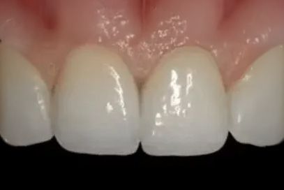 A close up of a person 's smile with white teeth.
