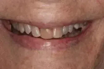 A close up of a woman 's smile with white teeth.