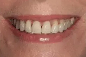 A close up of a person 's mouth with white teeth.