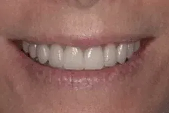 A close up of a person 's smile with white teeth.