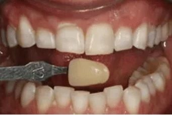 A close up of a person 's smile with white teeth.