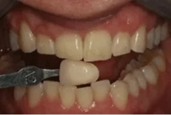 A close up of a person 's mouth with white teeth.