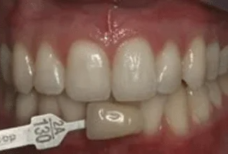 A close up of a person 's mouth with white teeth.