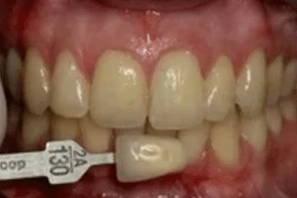 A close up of a woman 's smile with white teeth.