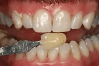 A close up of a man 's mouth with white teeth.