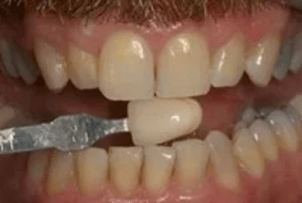 A close up of a man 's mouth with white teeth.