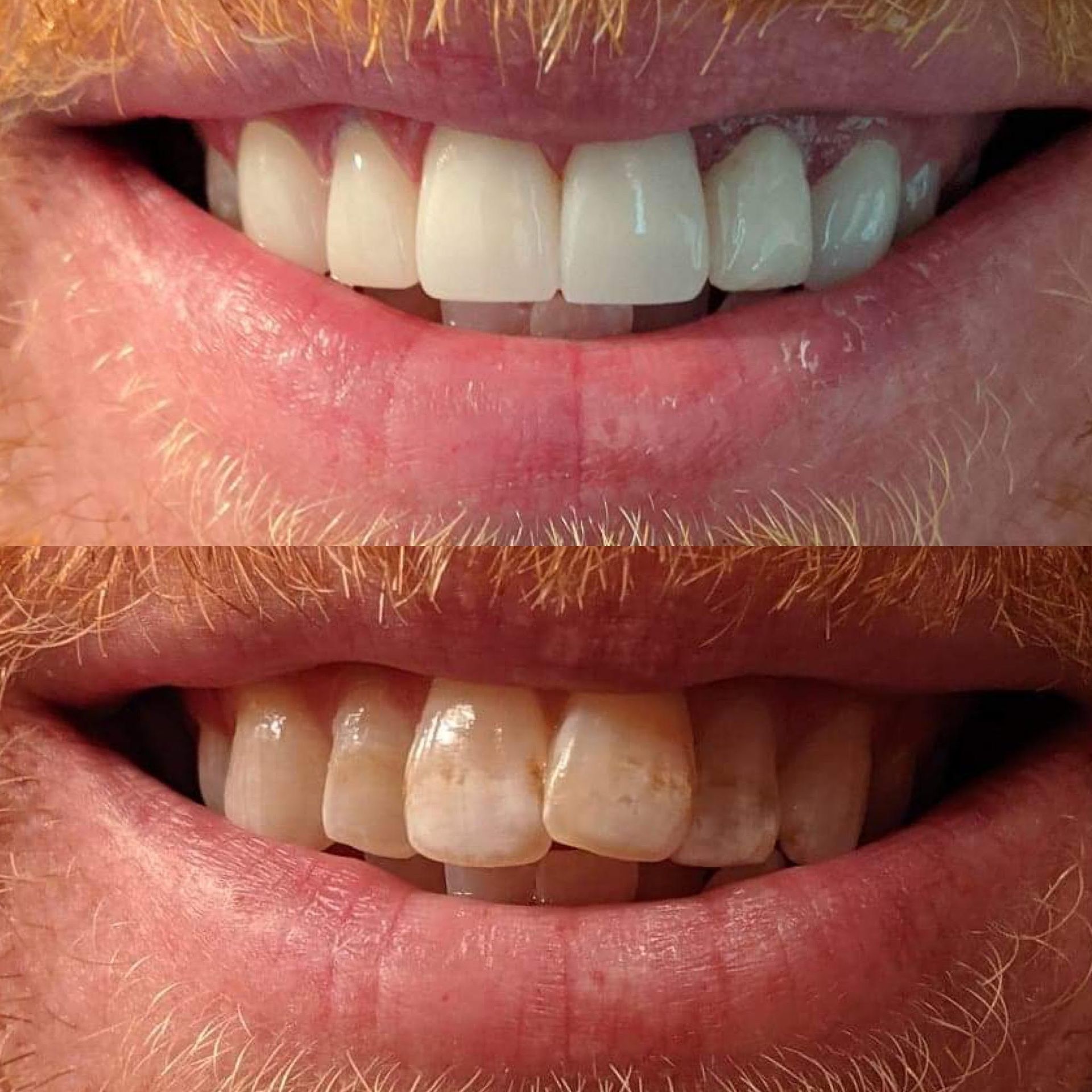Before-and-after of a smile, top teeth are bright white, and bottom teeth are stained and yellowed.