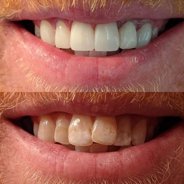 Before-and-after of a smile, top teeth are bright white, and bottom teeth are stained and yellowed.