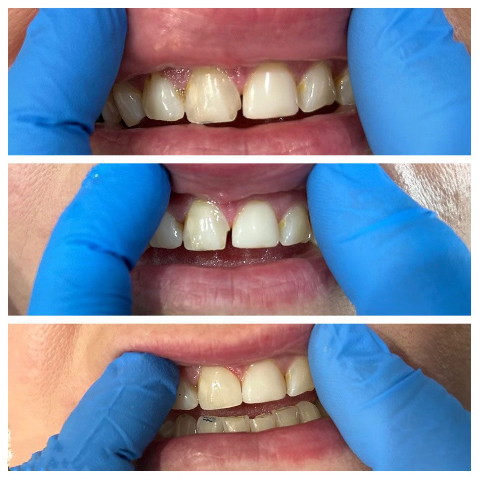 Teeth held open with gloved fingers, revealing chipped and discolored teeth, possibly for dental examination.