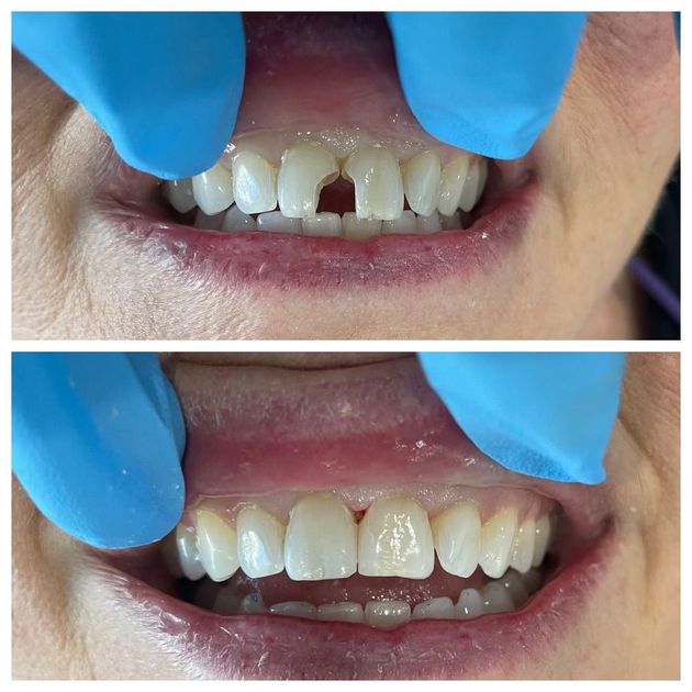 Top: Close-up of a person with a chipped front tooth. Bottom: Repaired front teeth, appearing whole and even.