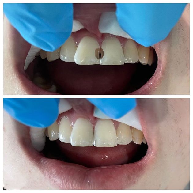 Top: Teeth before and after dental work on front tooth with a hole. Bottom: Completed repair.