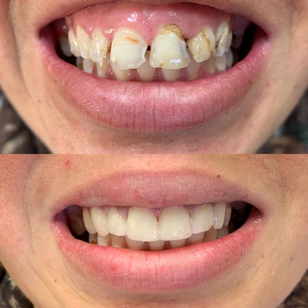 Before and after: Mouth showing severely damaged teeth replaced with a straight, bright white smile.