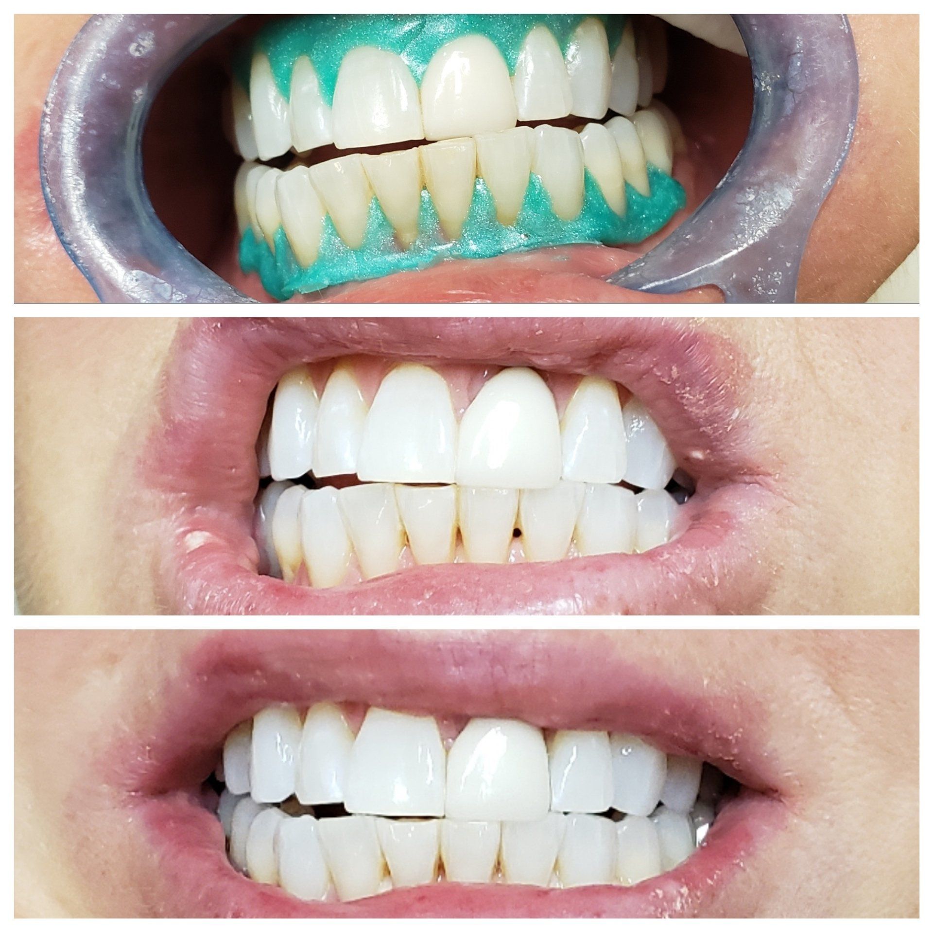 Teeth whitening process: application of blue gel, then before and after shots of whiter teeth.