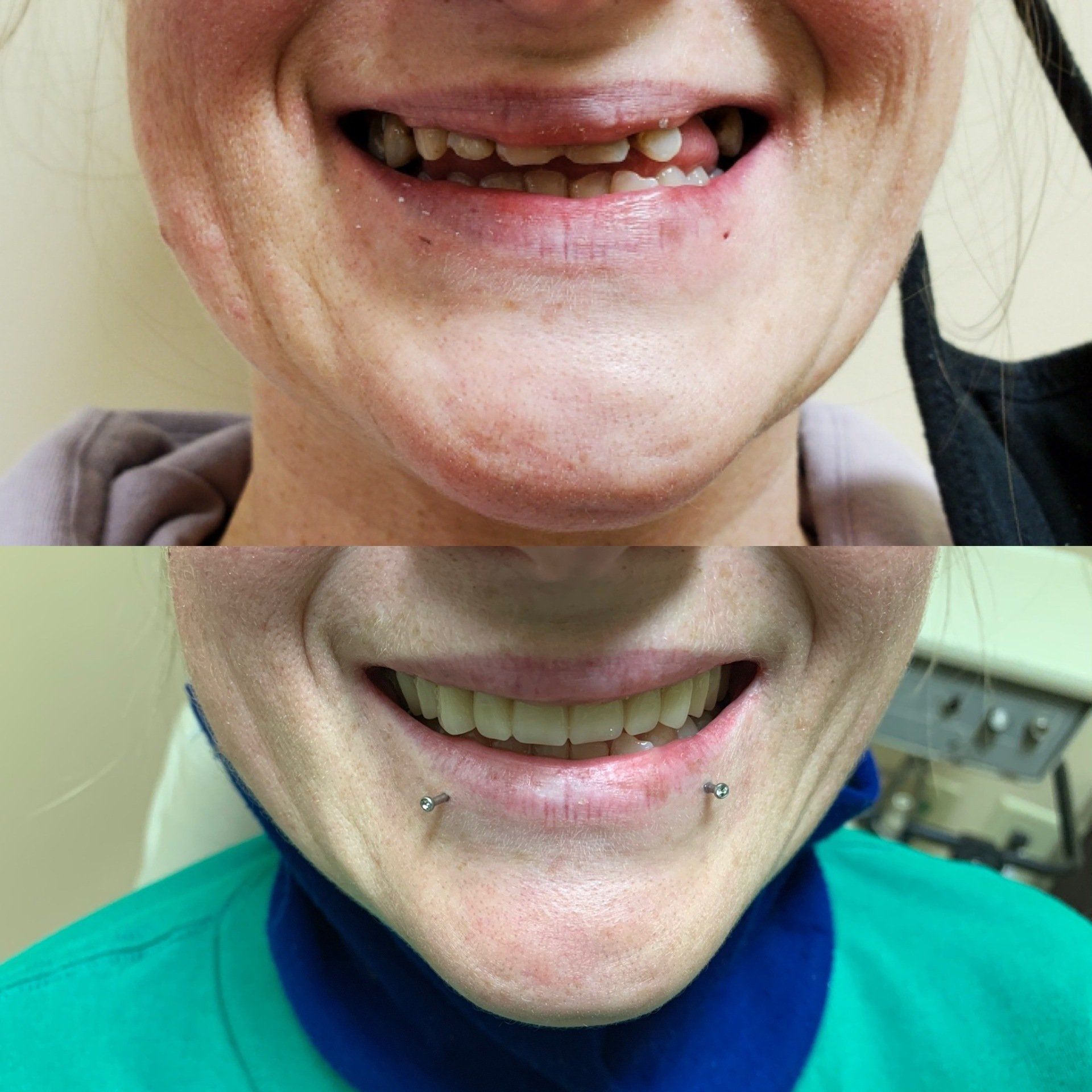 Before and after photos of a woman's smile. Top: missing teeth. Bottom: new teeth, lip piercings.
