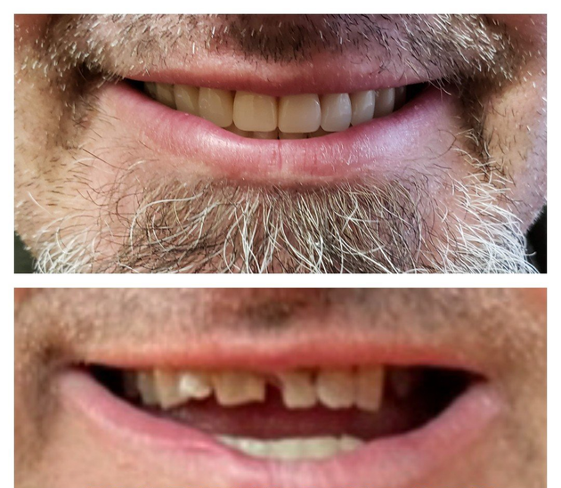 Top: Person with a full set of white teeth smiling. Bottom: Same person with missing front teeth smiling.