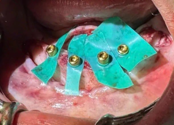 Surgical view of jaw bone with green protective sheets and metal screws in place for dental implants.