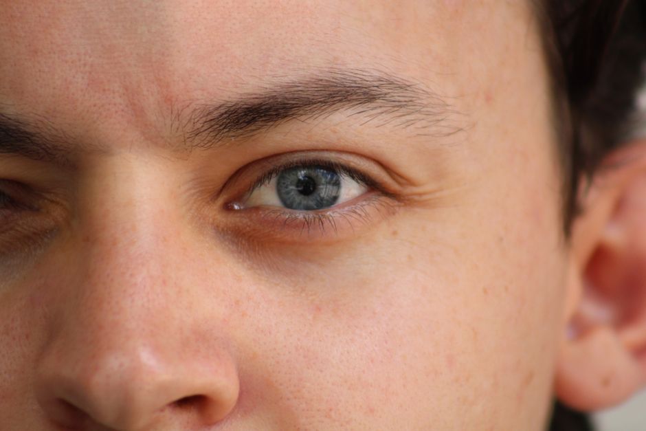 Smoother under-eye skin after Rejuran Eye treatment in Seoul