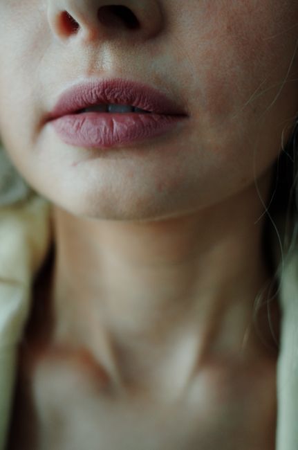 Natural-looking lips after subtle lip filler in Seoul