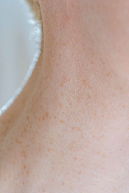 Skin texture after acne scar treatment sessions in Seoul
