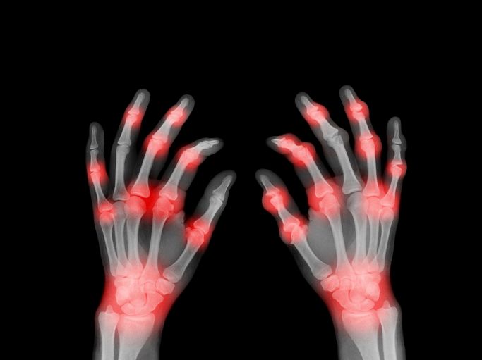 Una radiografia delle mani di una persona che mostra dolori alle articolazioni.