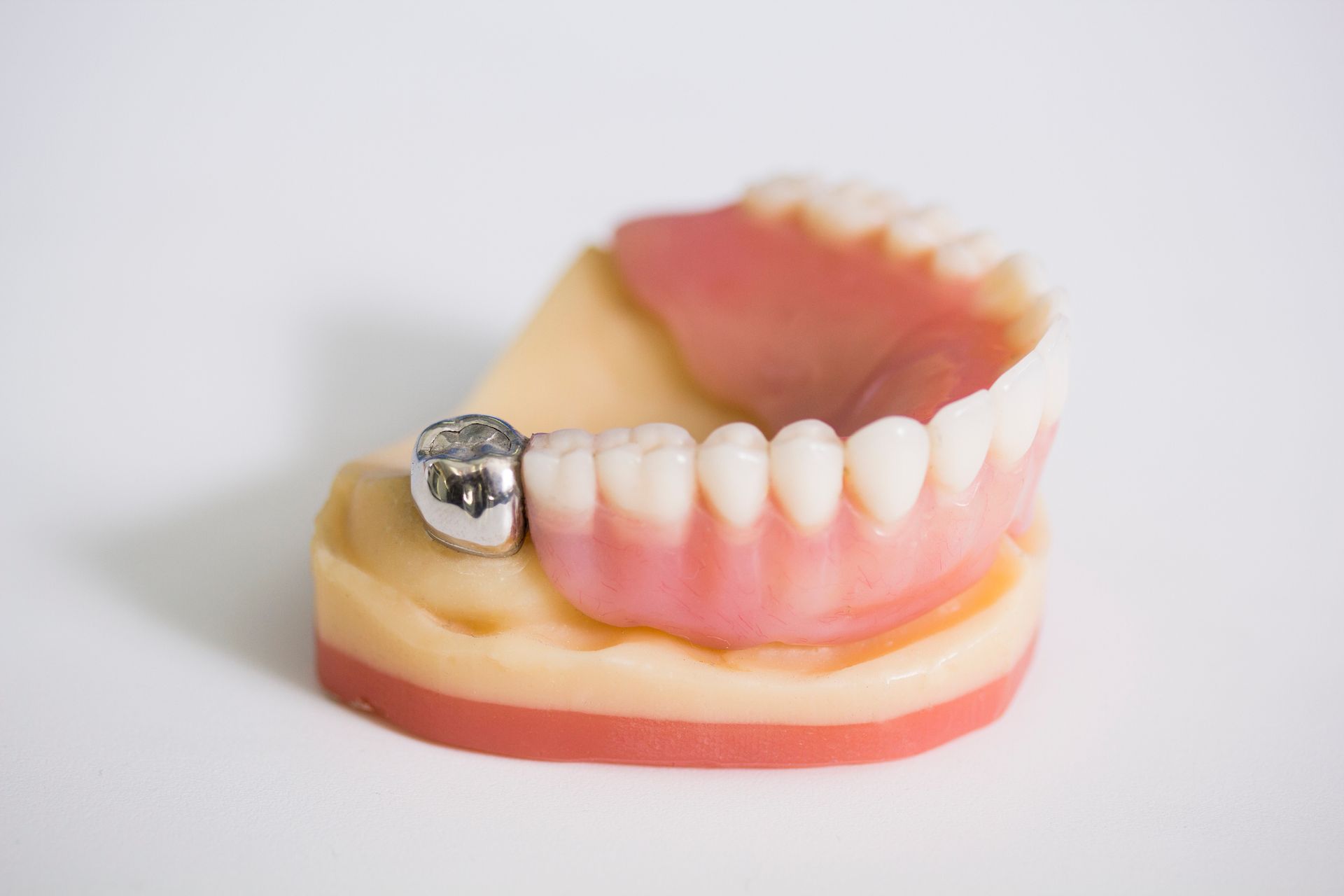 Root Canal Treatment and Dental Crowns A2Z Dental