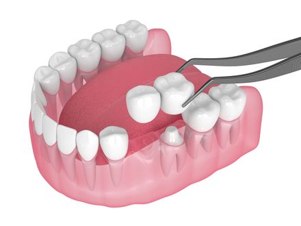 Partial Denture