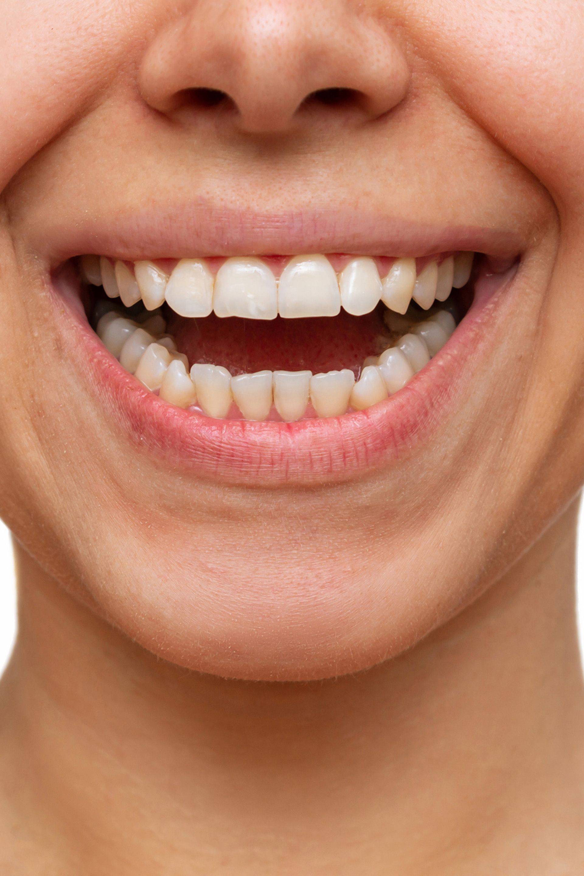 Smile Gallery