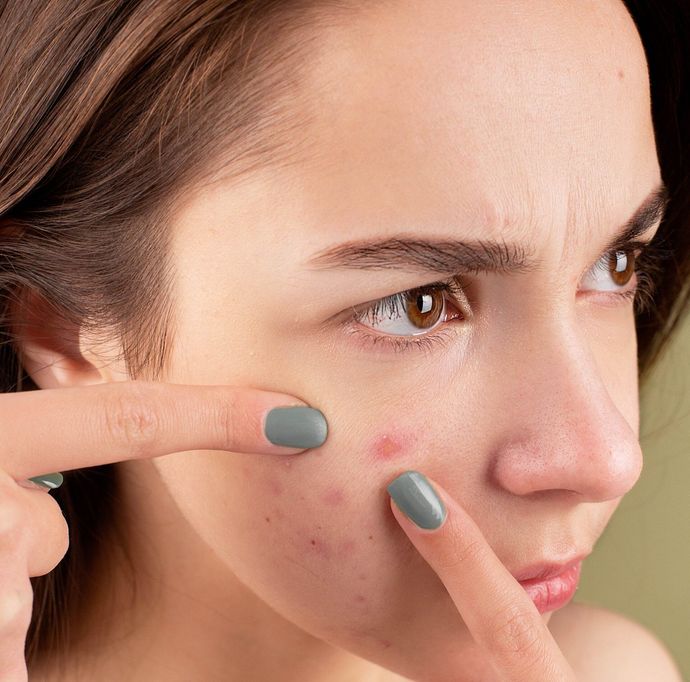 Woman with acne on her cheek, pointing at blemishes with fingers, concerned expression.