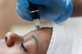 Woman getting microneedling treatment