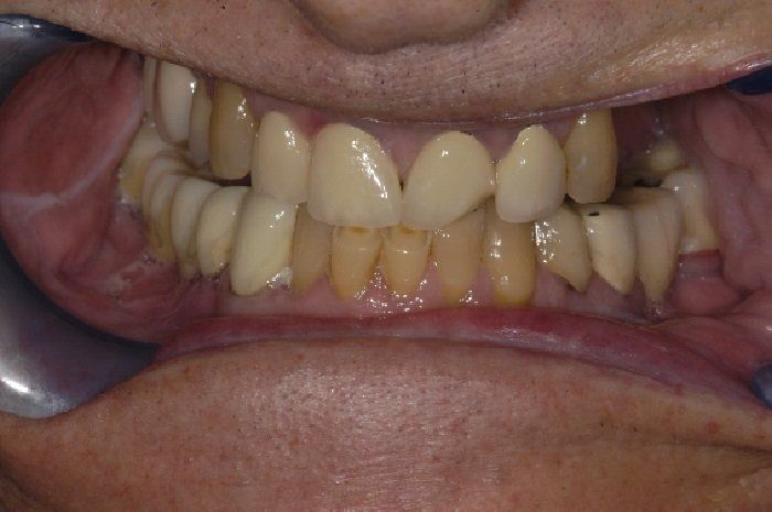 A close up of a person 's teeth with a mouth mirror.