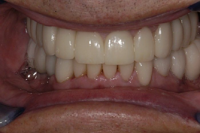 A close up of a man 's teeth with a metal crown in his mouth.