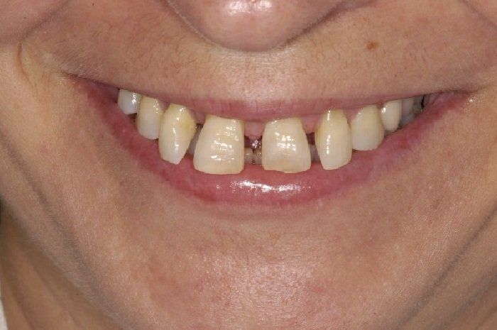 A close up of a woman 's smile with missing teeth.
