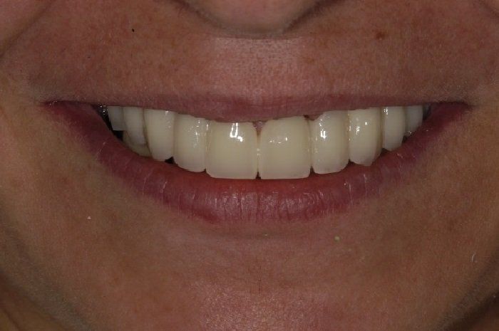 A close up of a woman 's smile with white teeth.