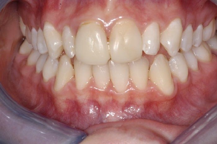 A close up of a person 's teeth in a mouth guard.