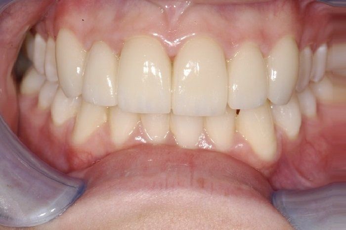 A close up of a person 's teeth with a mouth guard.
