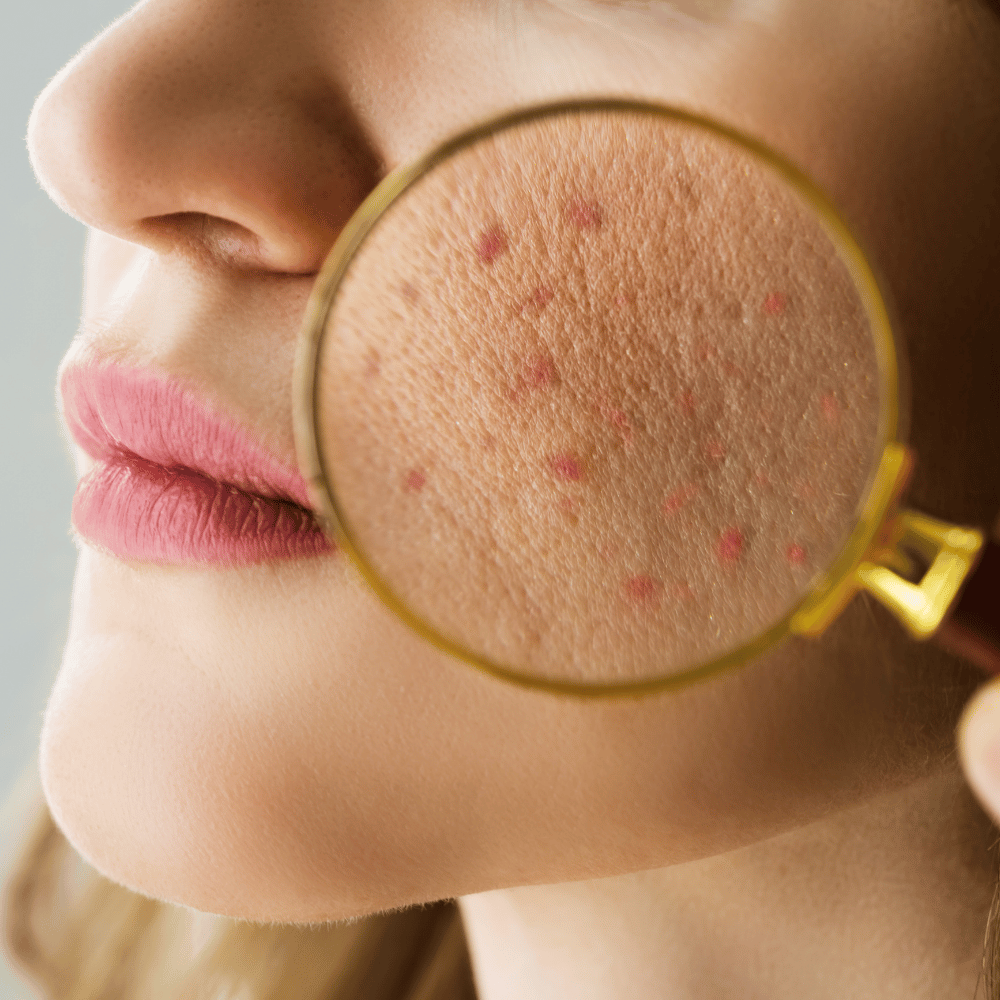 Acne and acne scar treatment by board-certified dermatologists in Seoul