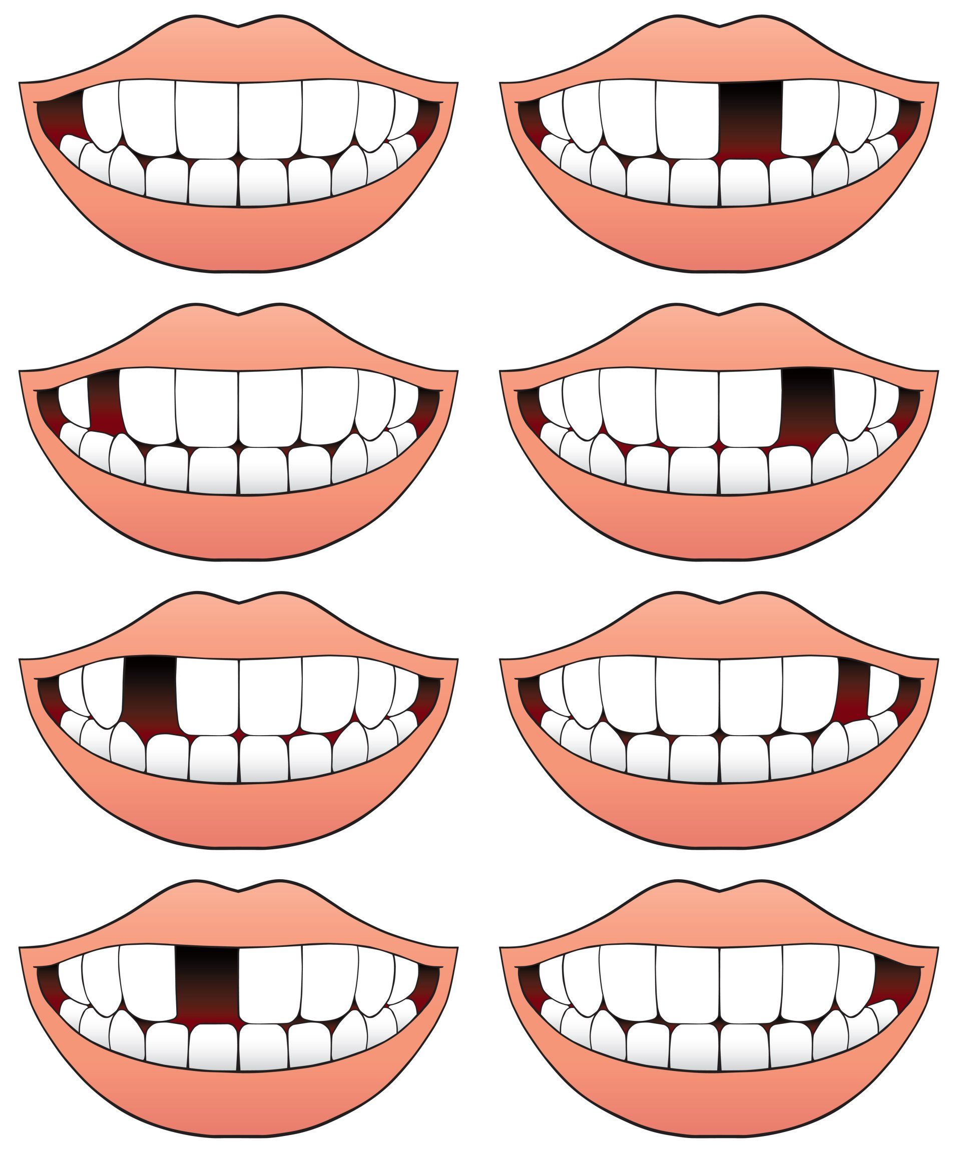fixing a tooth gap