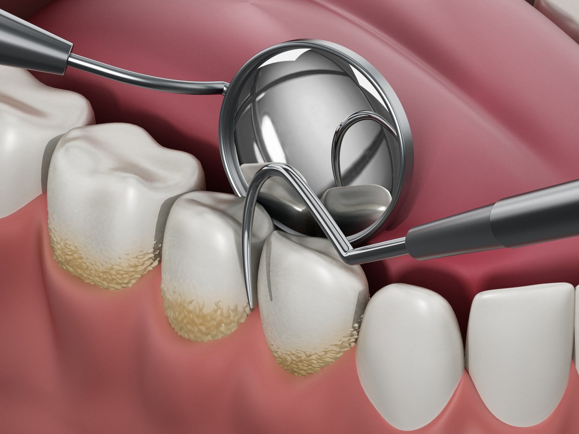 Plaque vs. Tartar