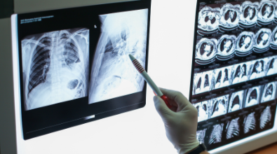 A person is pointing at an x-ray of a person 's chest.