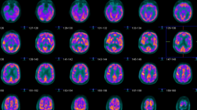 A bunch of images of a person 's brain are displayed on a black background.