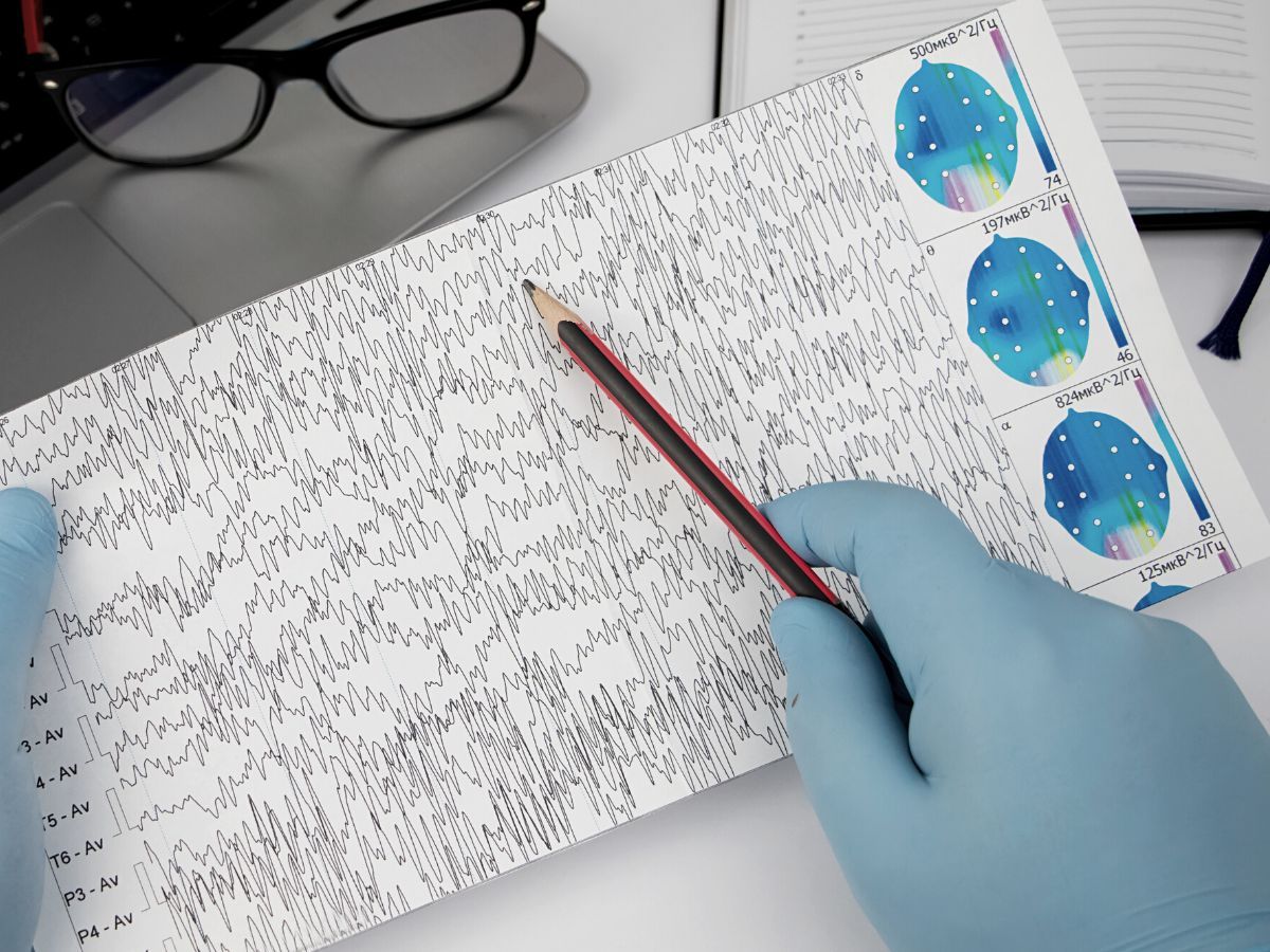 Tratamento para Epilepsia em São Paulo Tratamento para Epilepsia em São Paulo