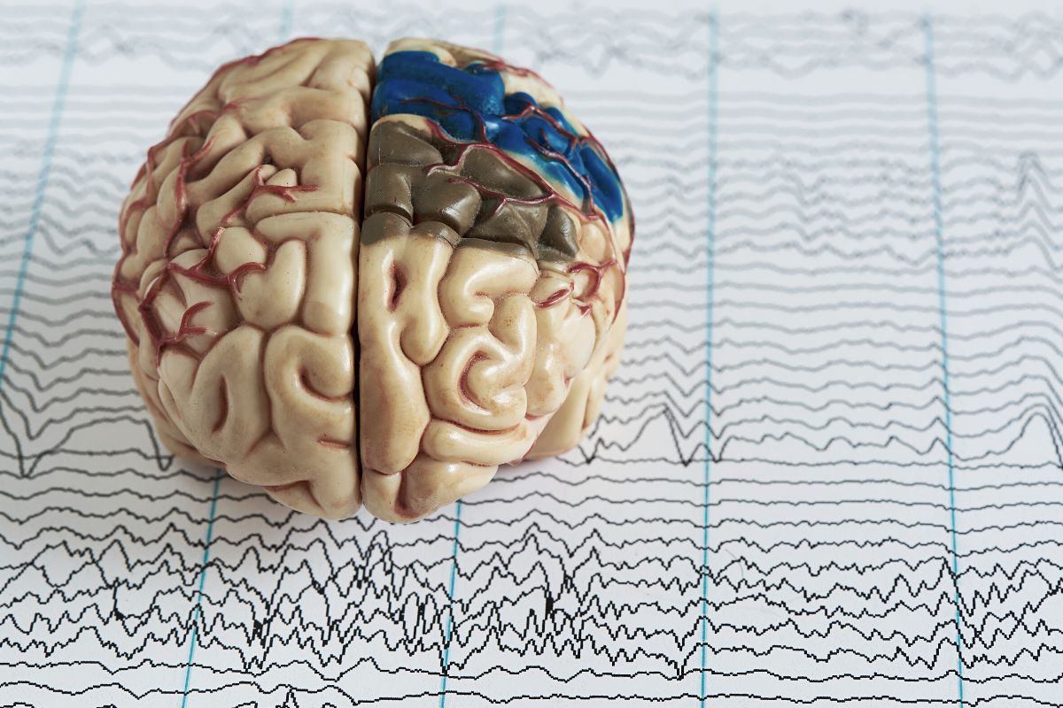 Hoje vamos falar de Epilepsias em diferentes idades, mas...