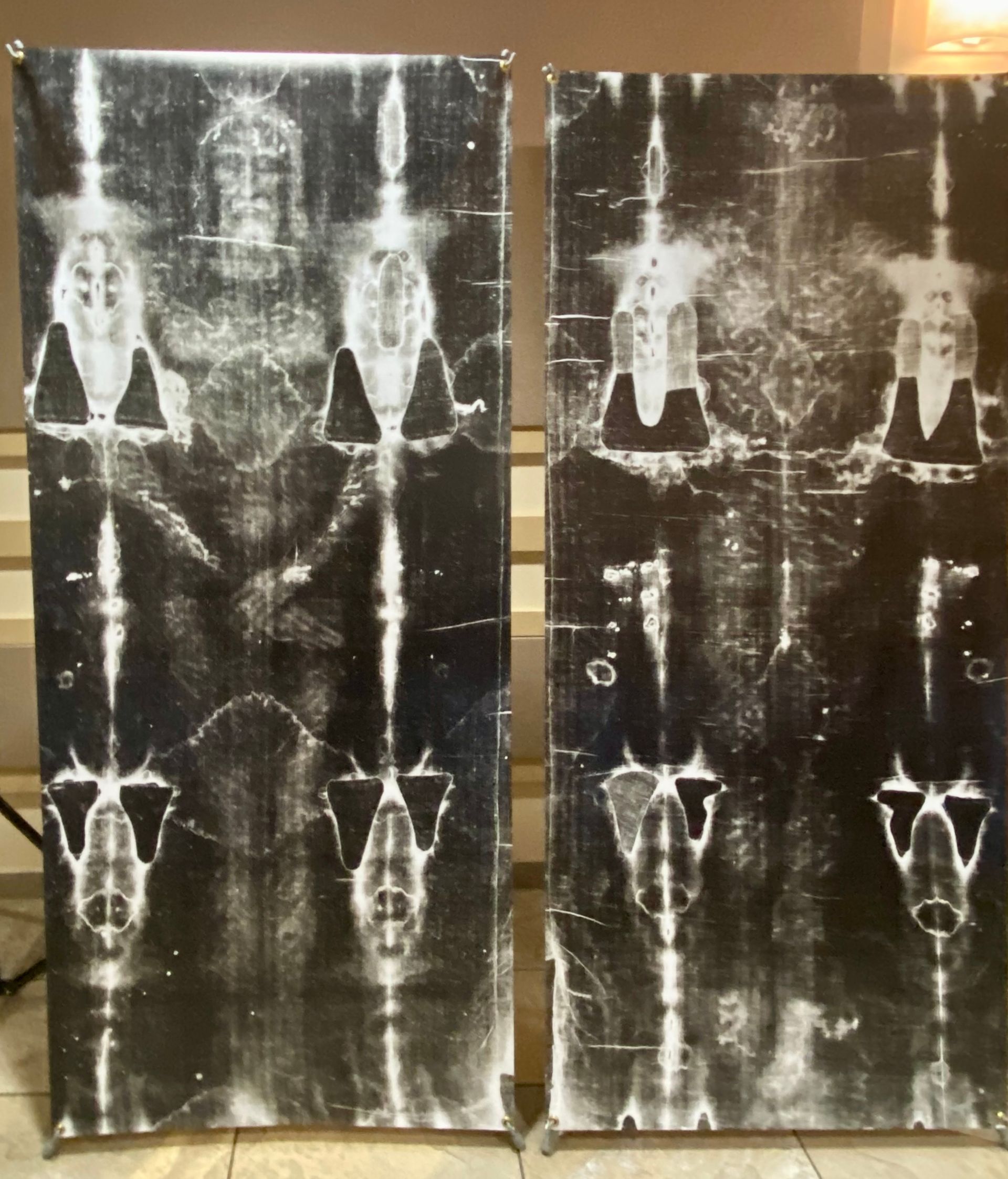 Two black-and-white X-ray films mounted side by side, showing skeletal pelvis and legs.