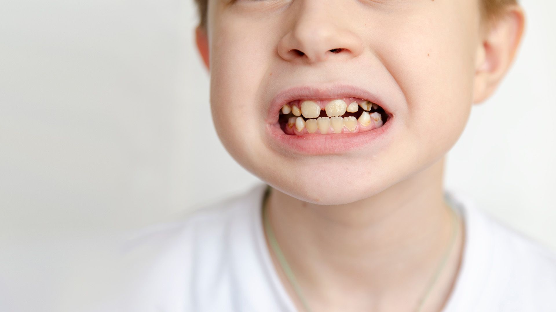 Why Are My Child’s Teeth Yellow? Causes, Prevention, and Treatment