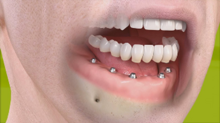 Implant supported denture