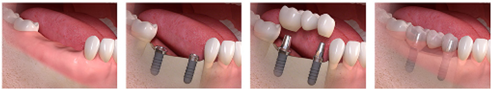 Implant supported bridge